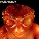 Anencephaly